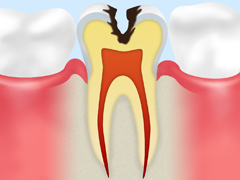 C2【象牙質の虫歯】