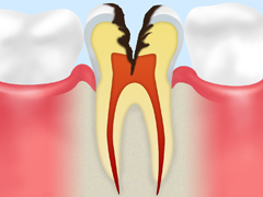 C3【神経まで達した虫歯】