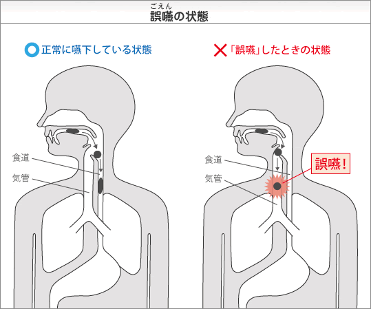 誤嚥の状態